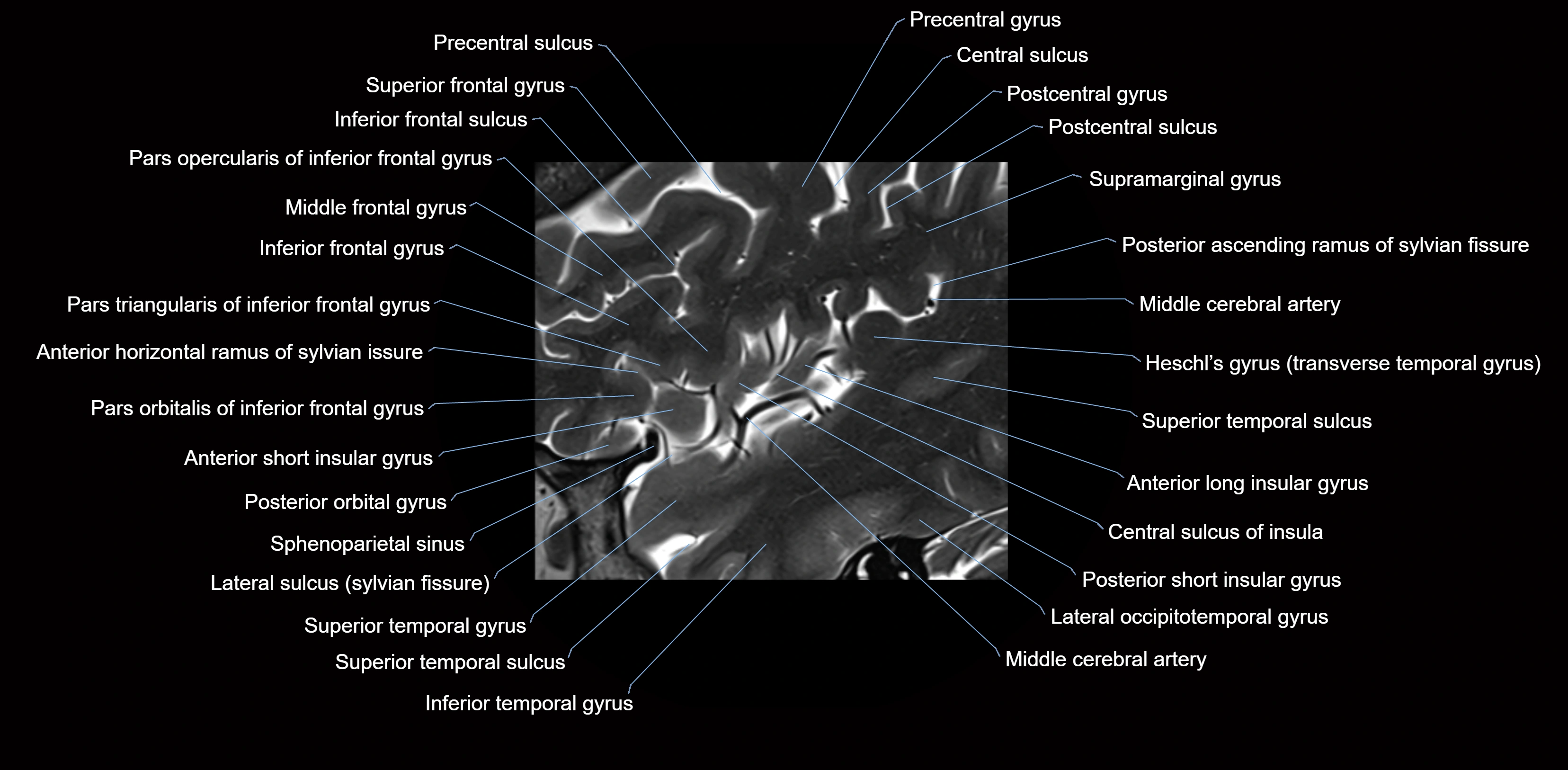 Insula cross section anatomy MRI sagittal 3t labelled image-img-00004.webp